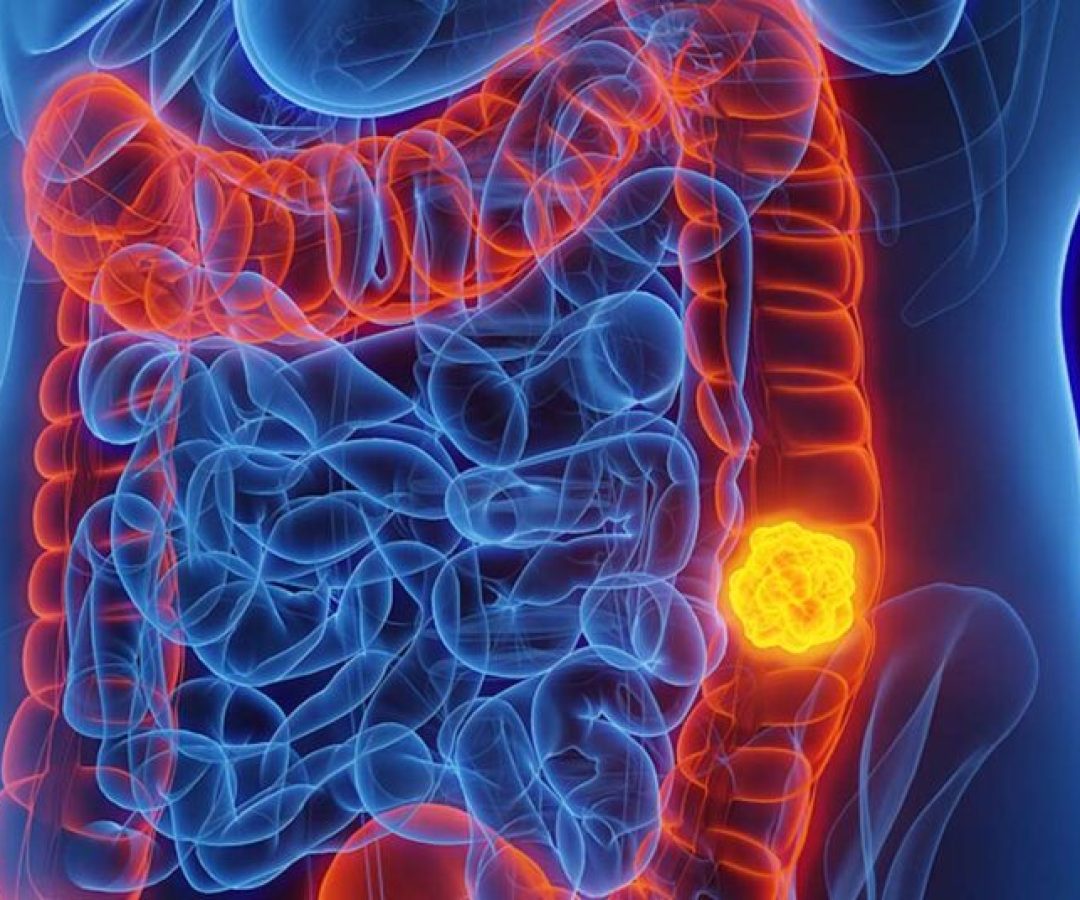 Sinais-e-sintomas-do-Cancer-Colorretal-1024x536-1